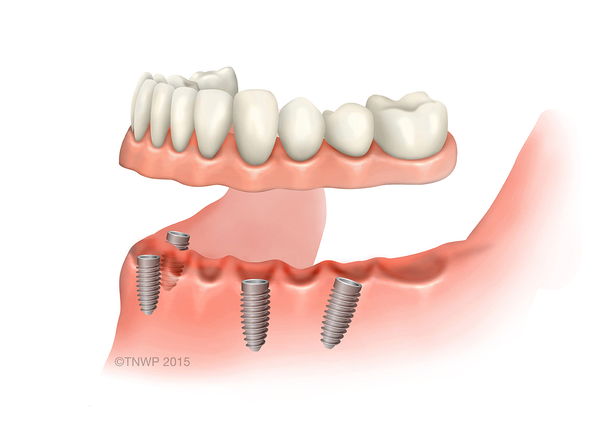 False teeth denture alternatives Implant supported complete arch